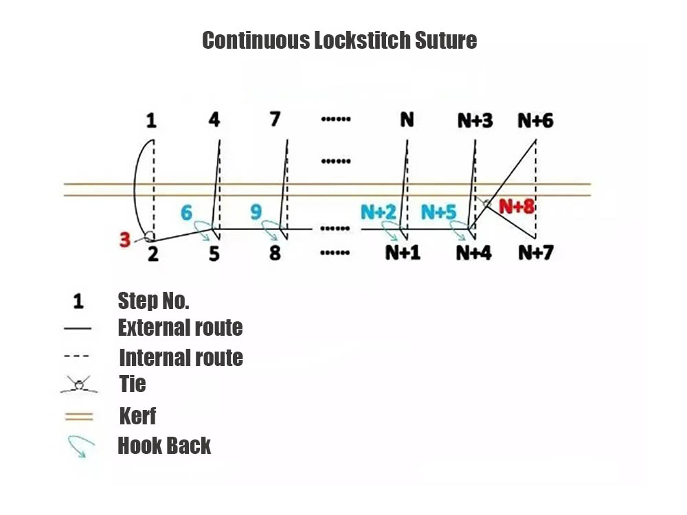 Continuous Lockstitch Suture-2