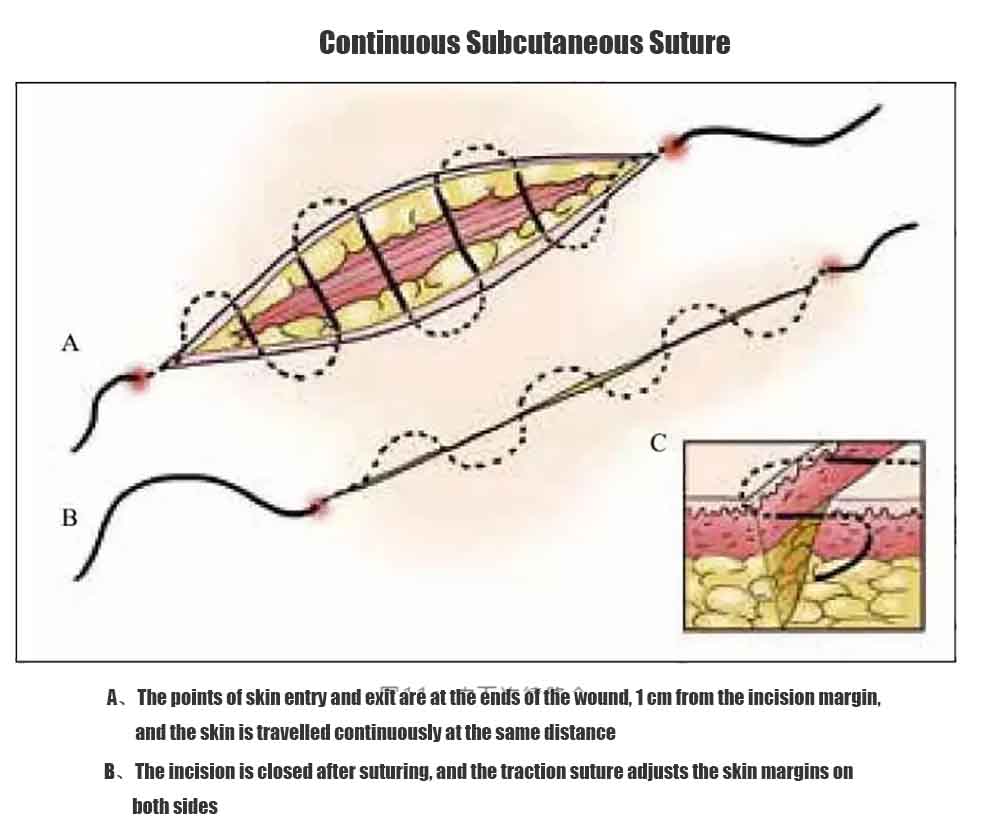 Continuous Subcutaneous Suture