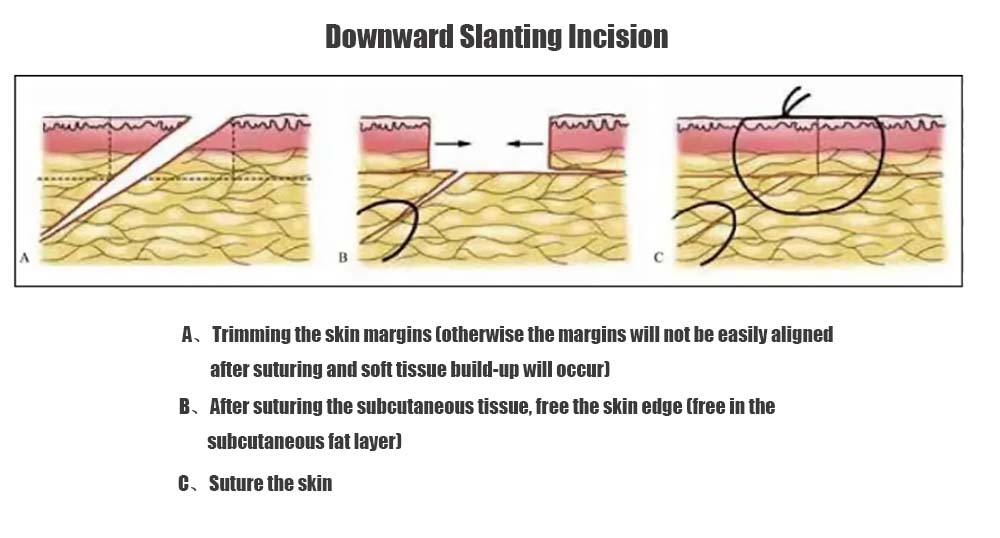 Downward Slanting Incision