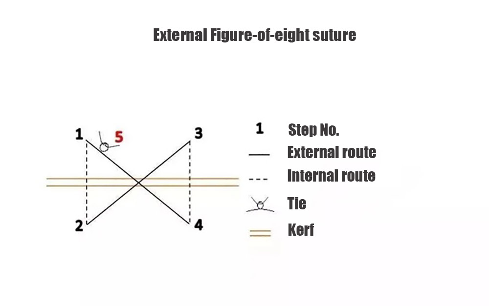 External Figure-of-eight suture