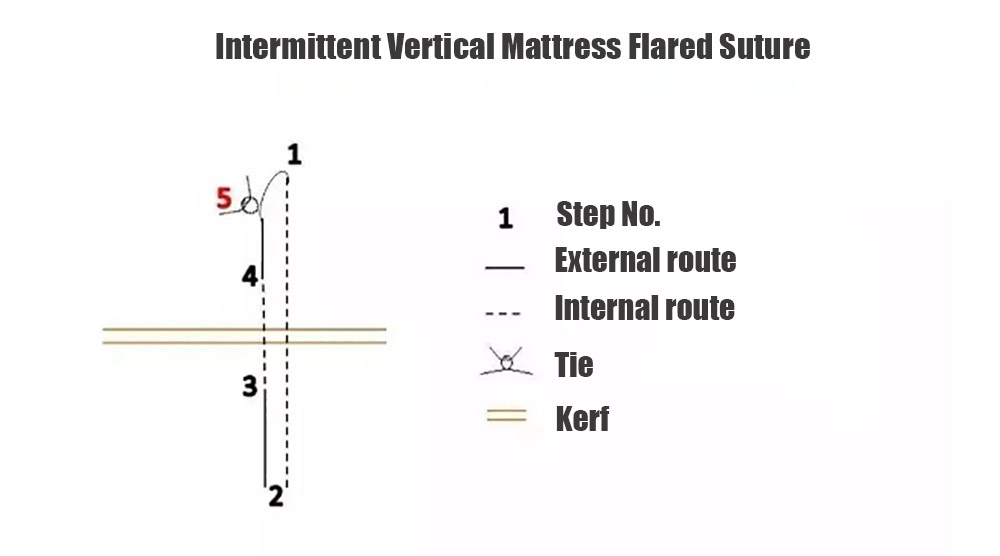 Intermittent Vertical Mattress Flared Suture