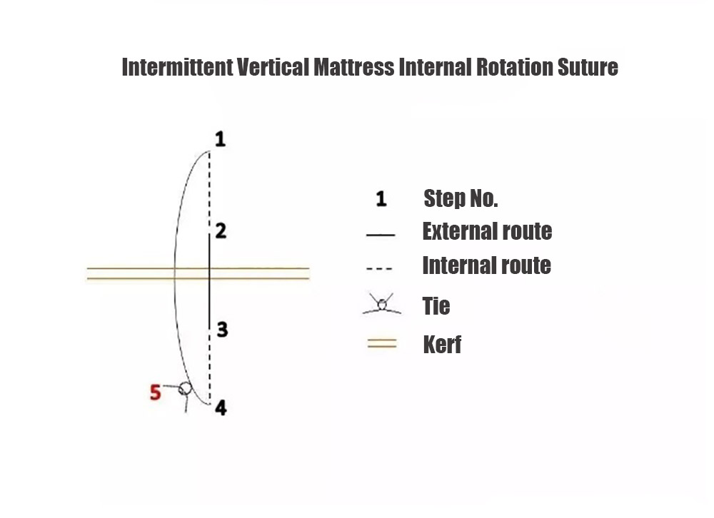 Intermittent Vertical Mattress Internal Rotation Suture