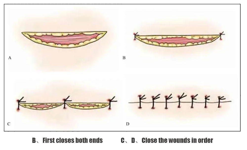 Irregular Wound Suturing Techniques-2