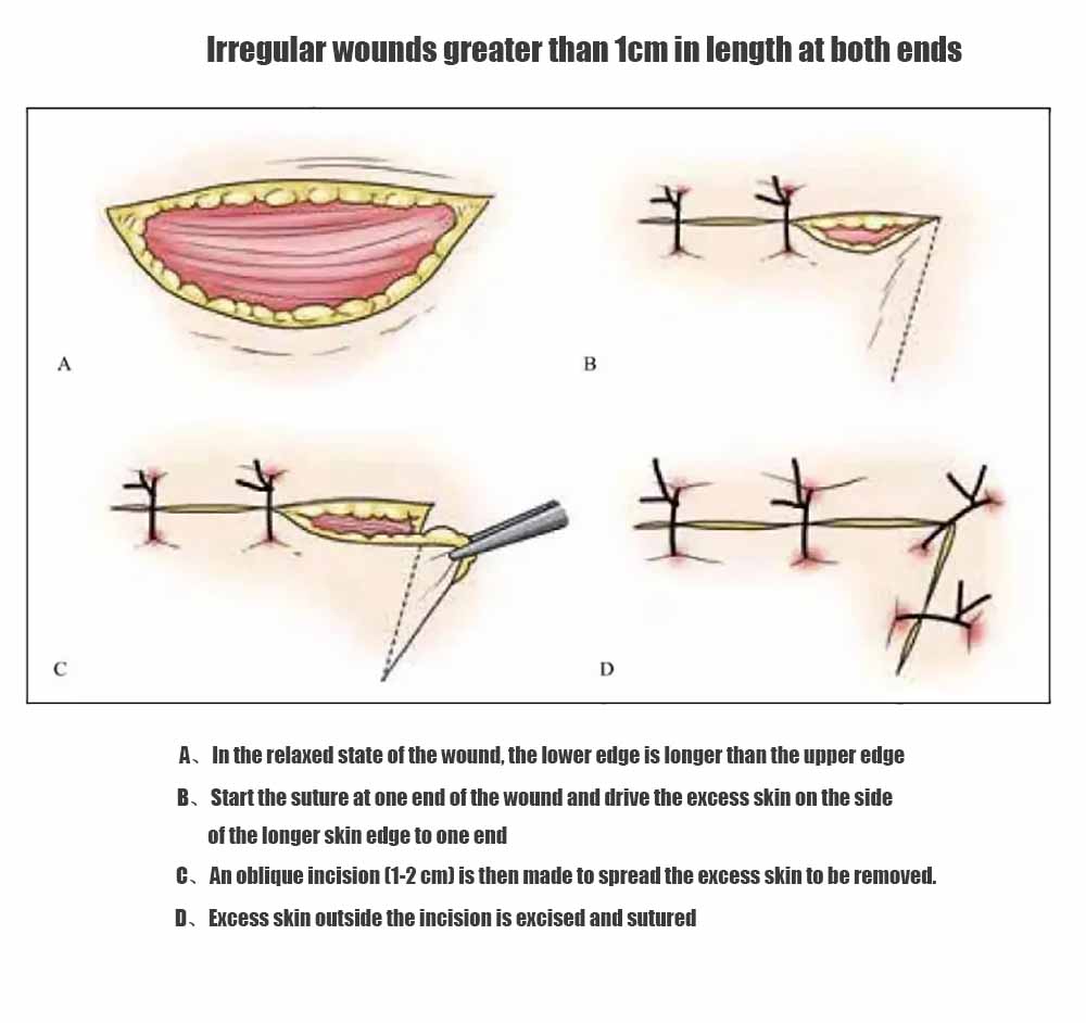 Irregular wounds greater than 1cm in length at both ends