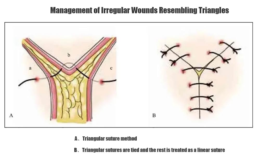 Management of Irregular Wounds Resembling Triangles-2