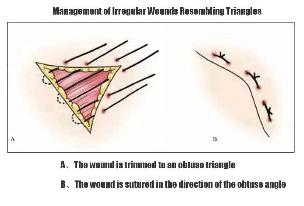 Management of Irregular Wounds Resembling Triangles