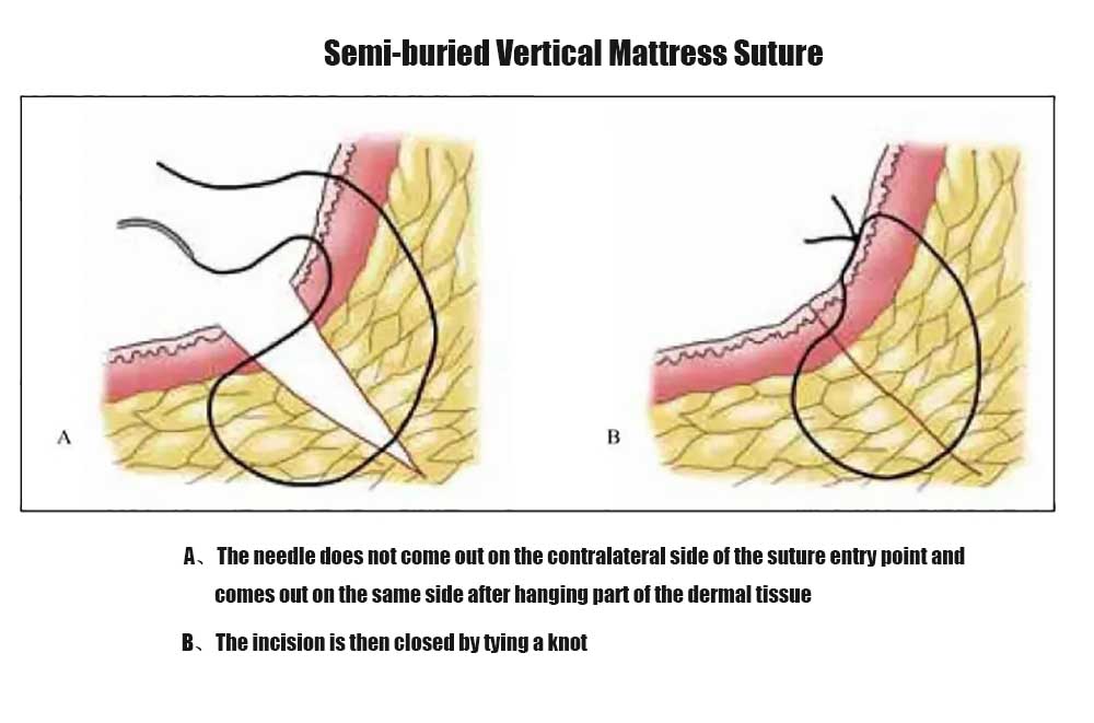 Semi-buried Vertical Mattress Suture