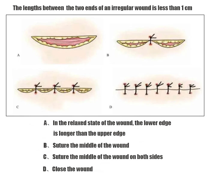 The lengths between the two ends of an irregular wound is less than 1 cm