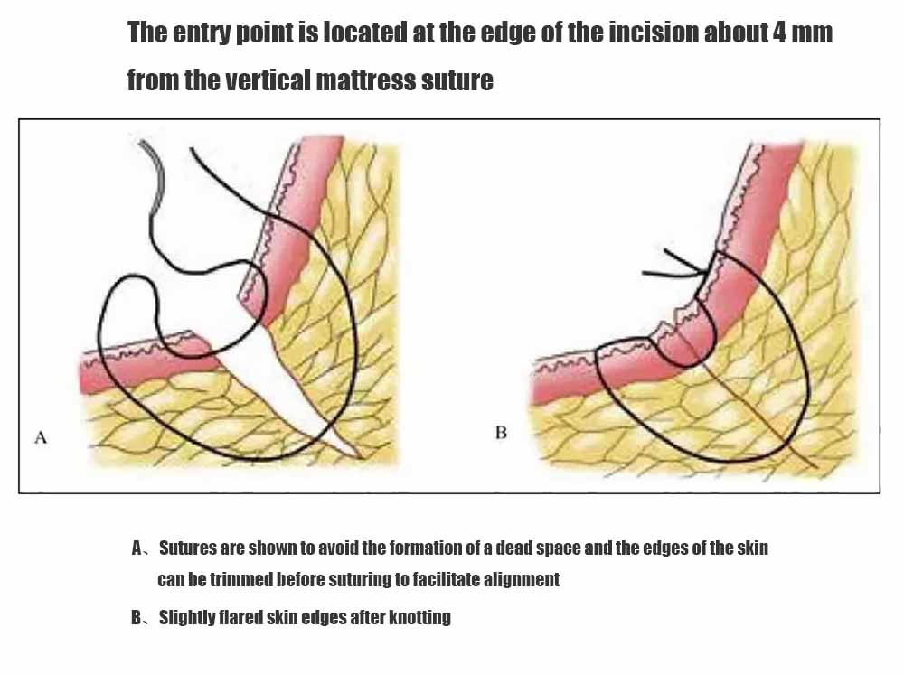 Vertical Mattress Suturing